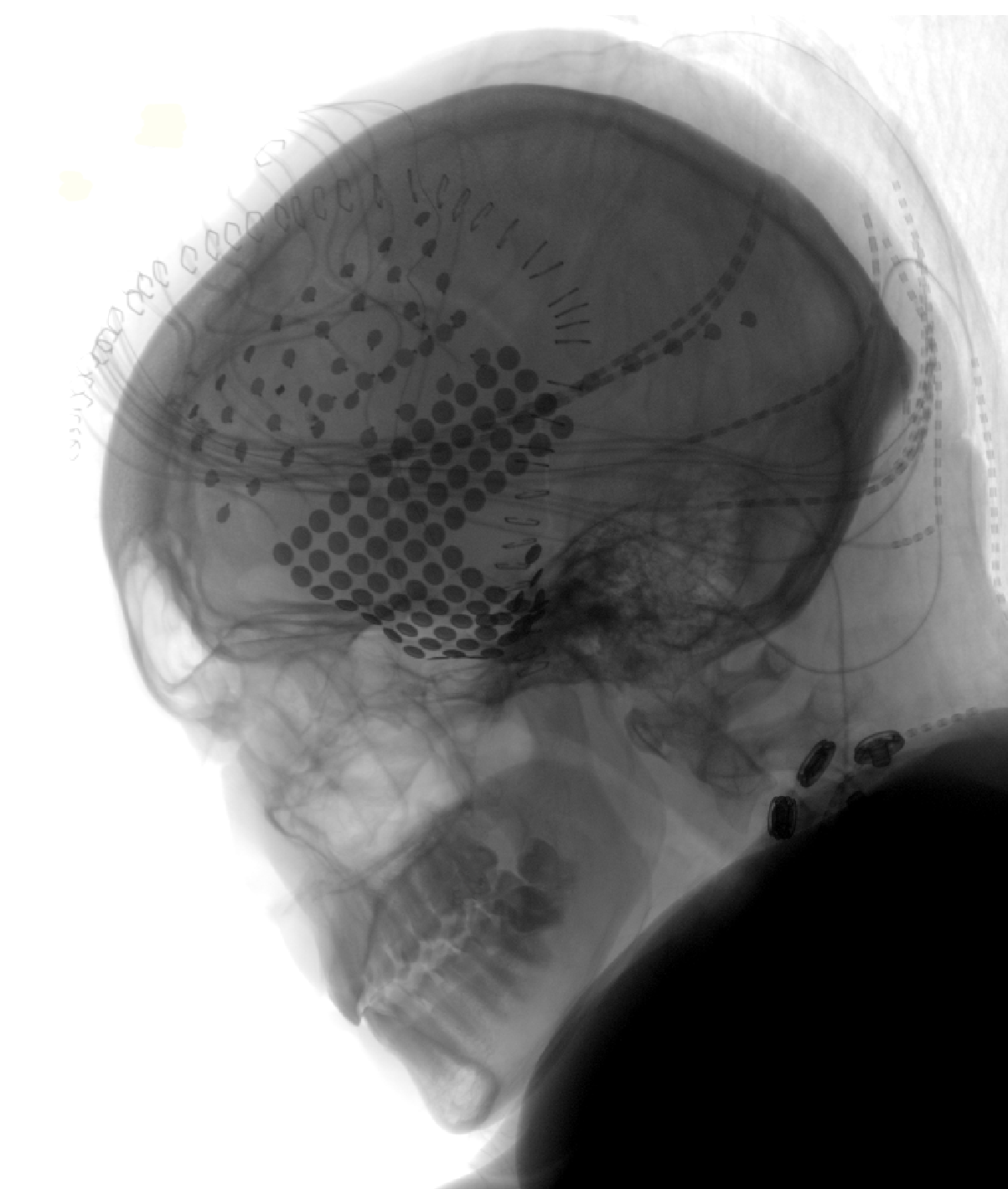 Removing electrodes 