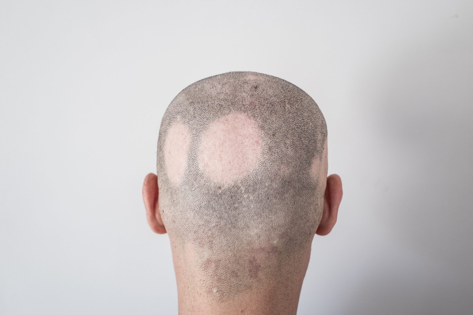 Was ist Alopecia areata?