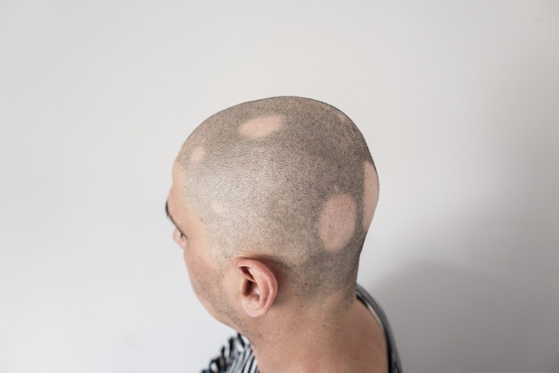 O que causa a alopecia areata?
