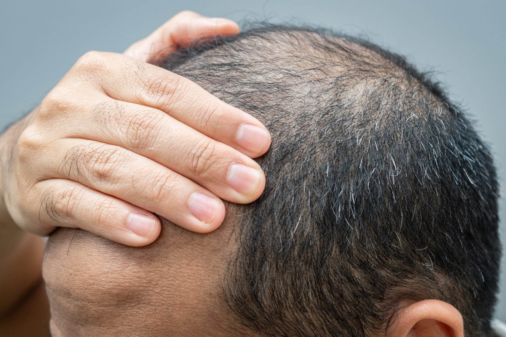 Revolutionäres Medikament könnte eine bestimmte Art von Alopezie stoppen
