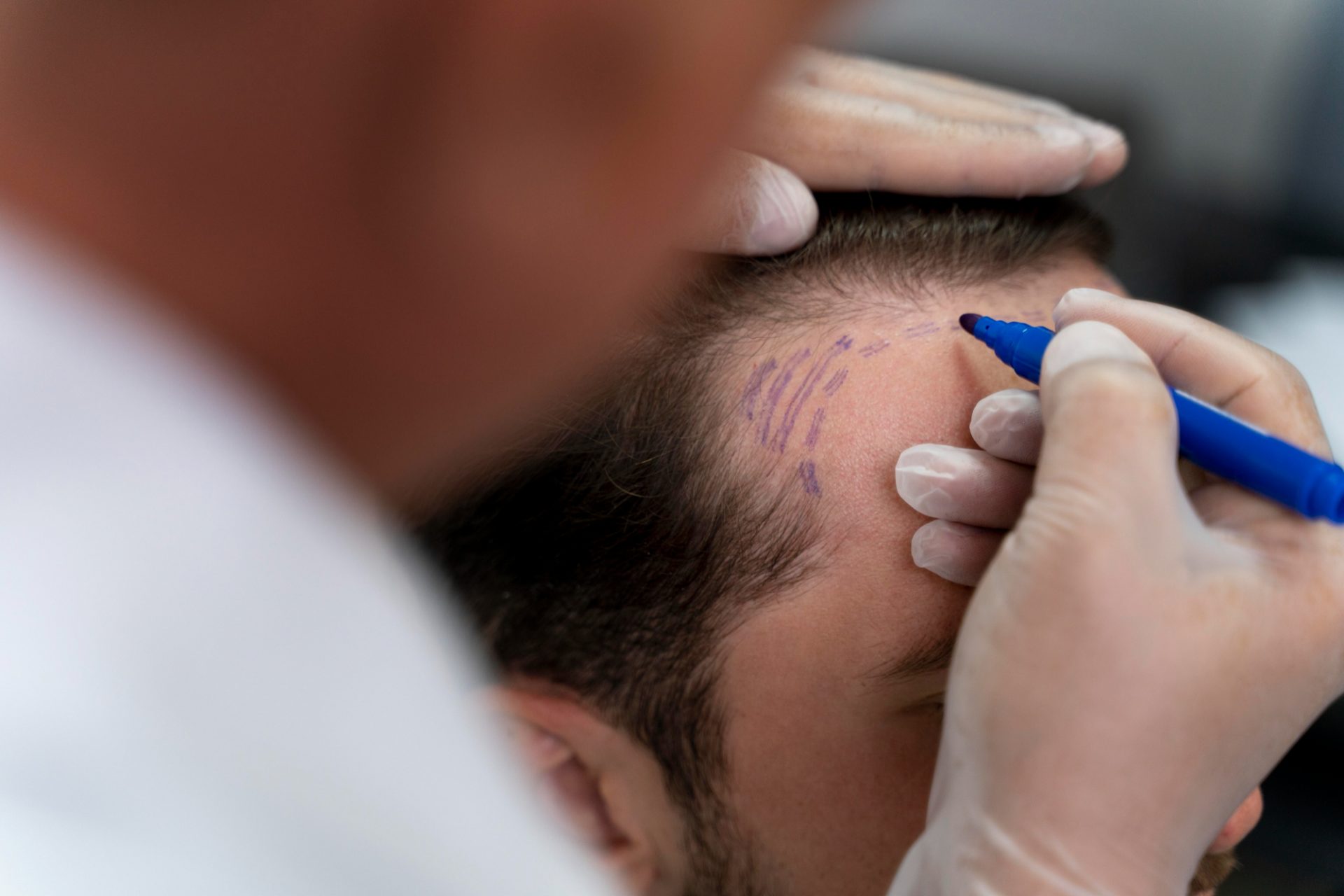 Tout connaître sur les greffes de cheveux