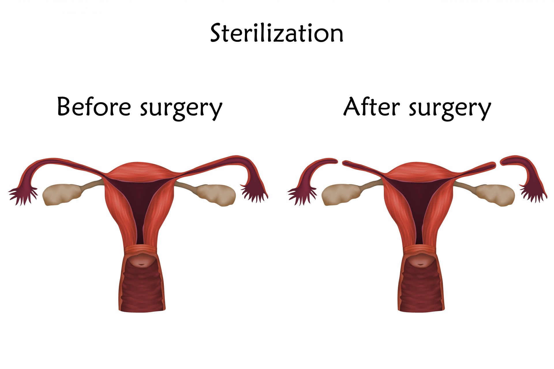 Understanding tubal sterilization