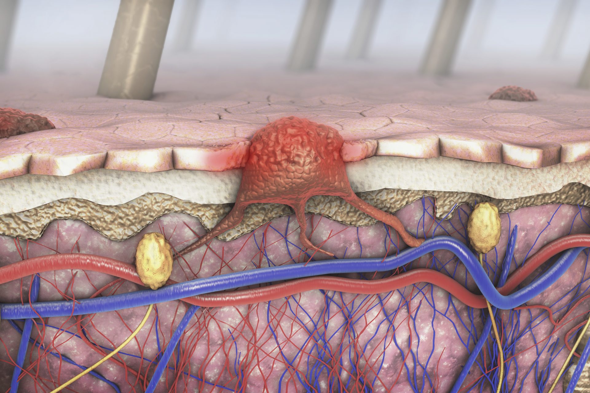 Evaluación directa de melanoma sin biopsia